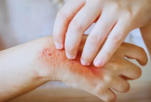 bolinhas vermelhas coçando por causa da alergia ao calor