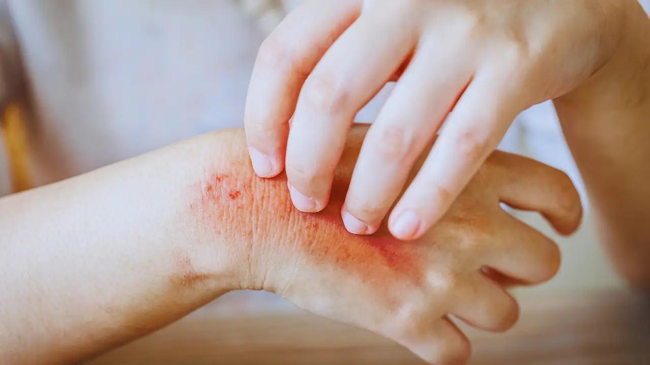 bolinhas vermelhas coçando por causa da alergia ao calor